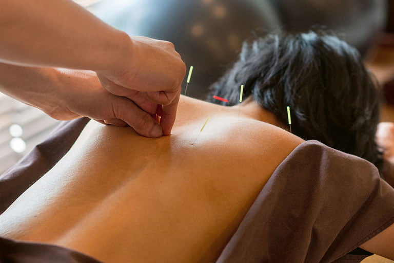 Akupunktur löst Verspannungen